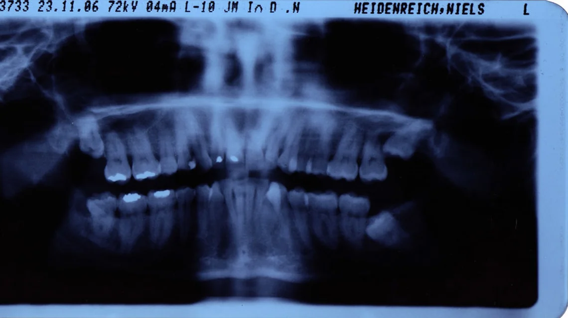 A panoramic dental X-ray of a full set of teeth